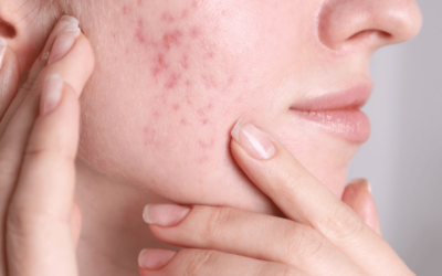 Microneedling for Scars: Why This Collagen-Boosting Treatment Is a Game Changer