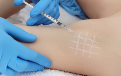 Botox Is Best Known for Smoothing Fine Lines — But It Does So Much More!